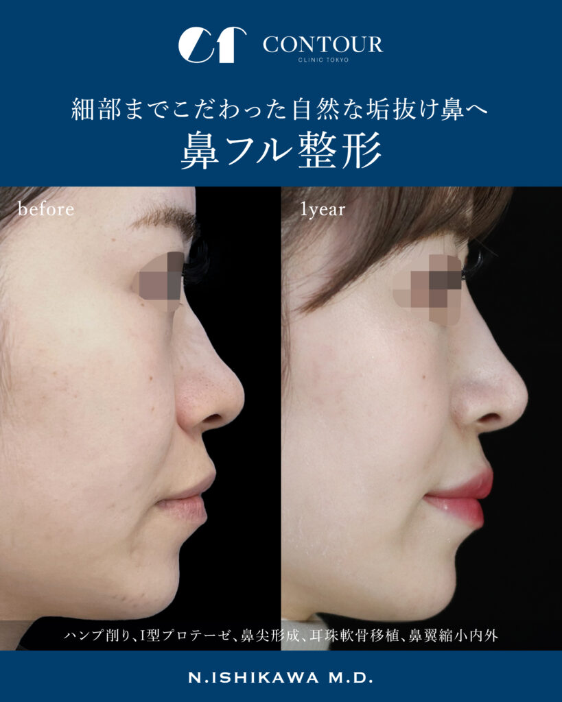 東京・銀座で鷲鼻（ハンプ）修正術なら｜【銀座駅より徒歩7分】コントアクリニック東京