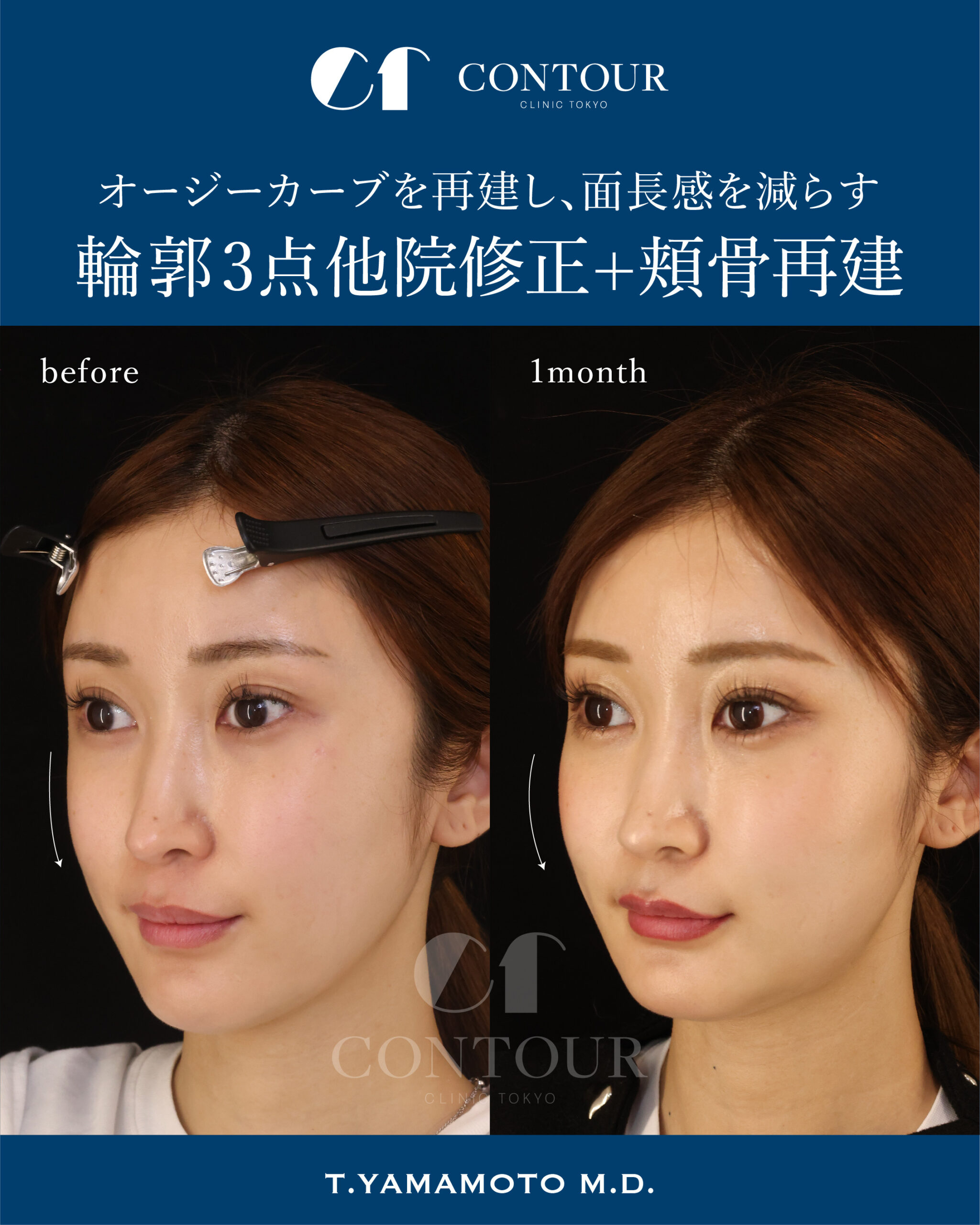輪郭3点他院修正＋頬骨再建術症例（20代女性） | コントアクリニック東京