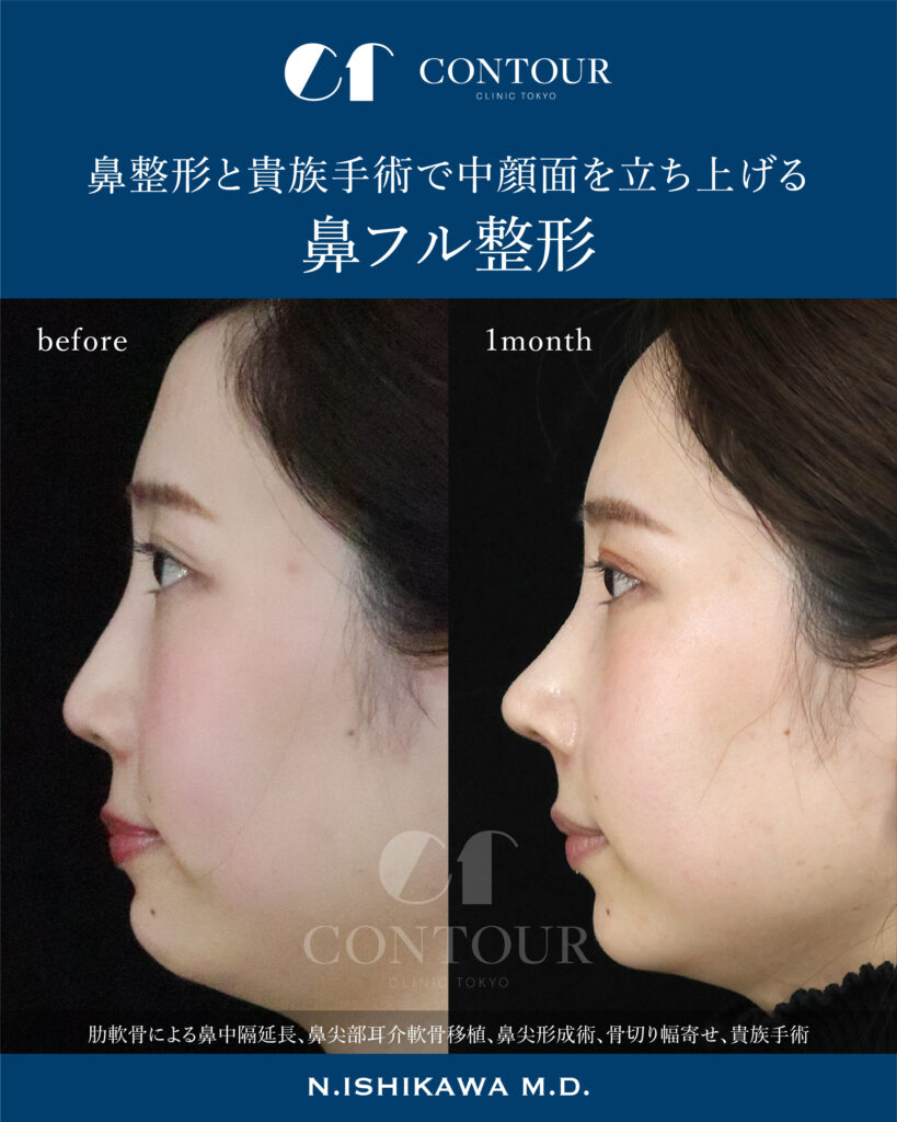 鼻 軟骨 移植