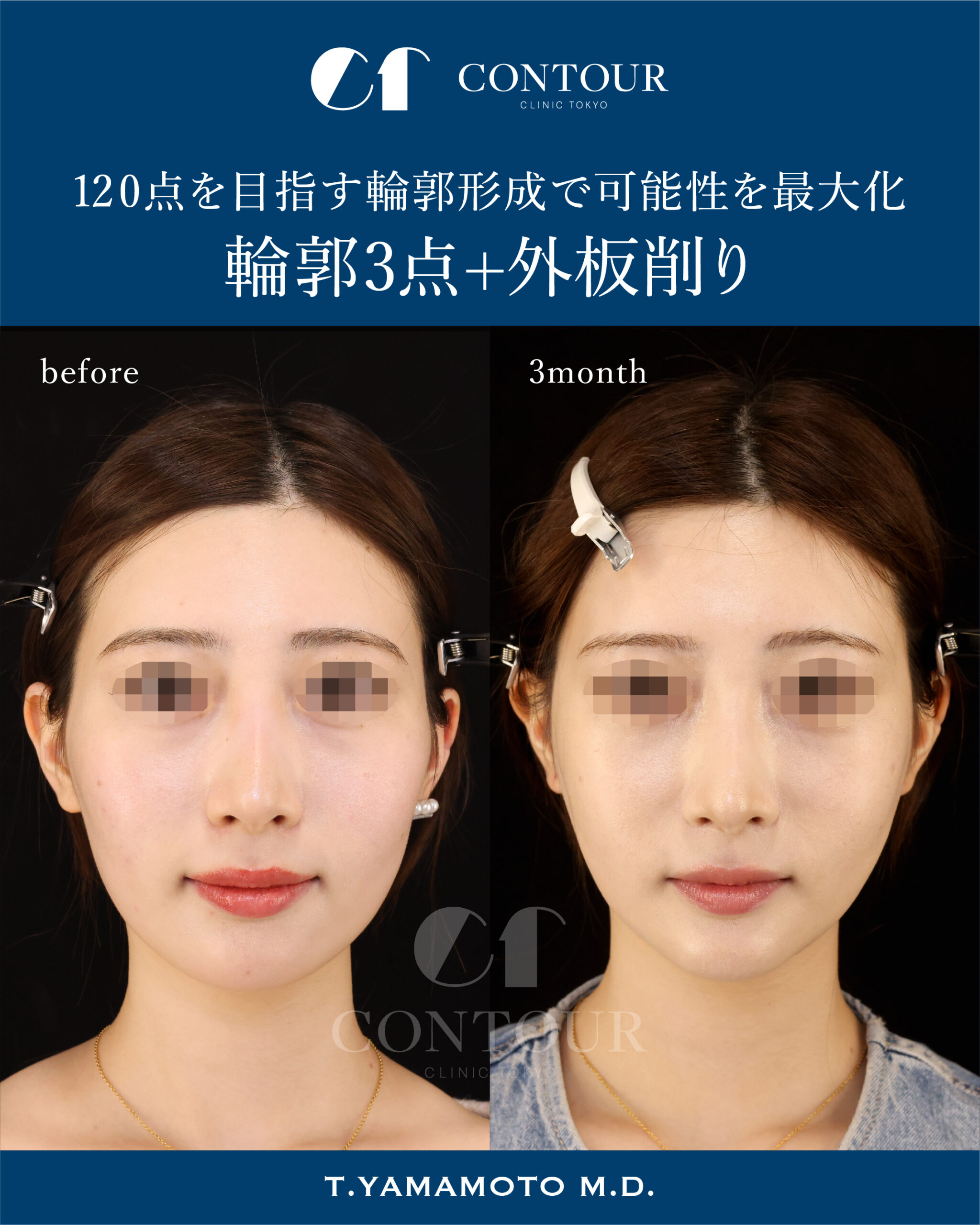 輪郭3点症例（20代女性） | コントアクリニック東京
