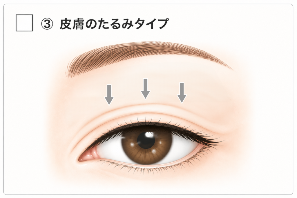 加齢による余剰皮膚で二重が隠れているまぶ