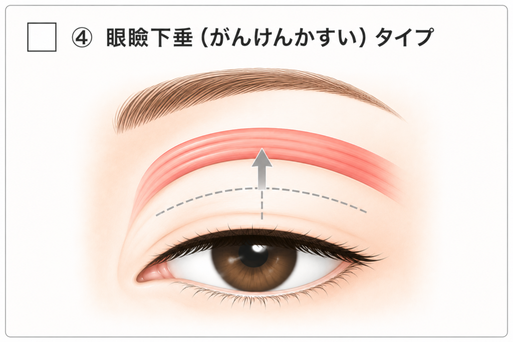 眼瞼下垂で瞼が上がりにくい状態のイラスト
